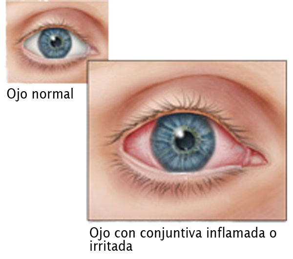 71 273 44023 1240418290 2 2803 SESA CONJUUNTIVITIS